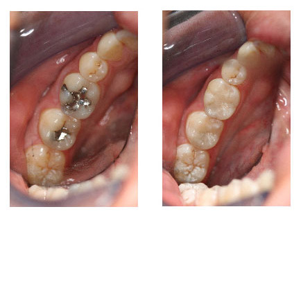 Amalgam Removal Before and After