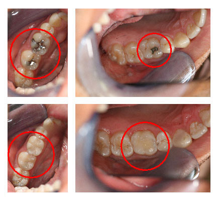 Amalgam Removal Before and After