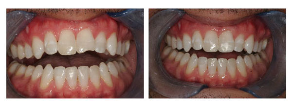 Chipped Tooth Repair Before and After